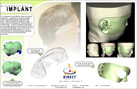 Projects - Prosthetic Ear Implant