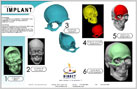 Projects - Skull Implant